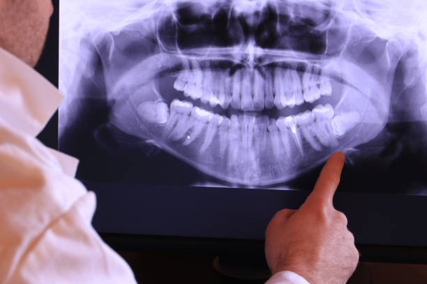 Best Emergency Wisdom Tooth Extraction in Bayard, NE